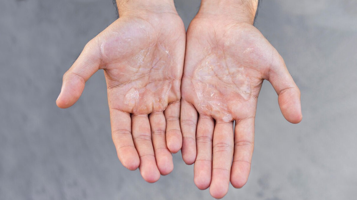 Sweaty Palms Causes