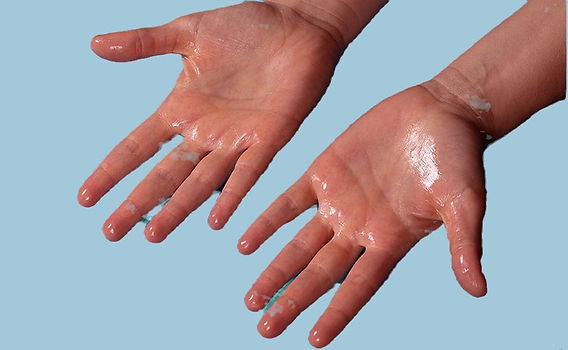 Sweaty Palms Causes